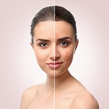 WOW Skin Science Anti Acne Face Serum